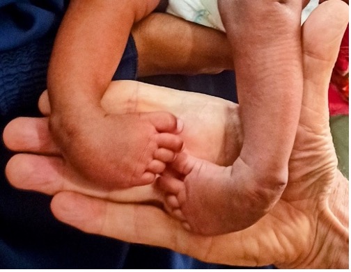 A newborn's clubfeet