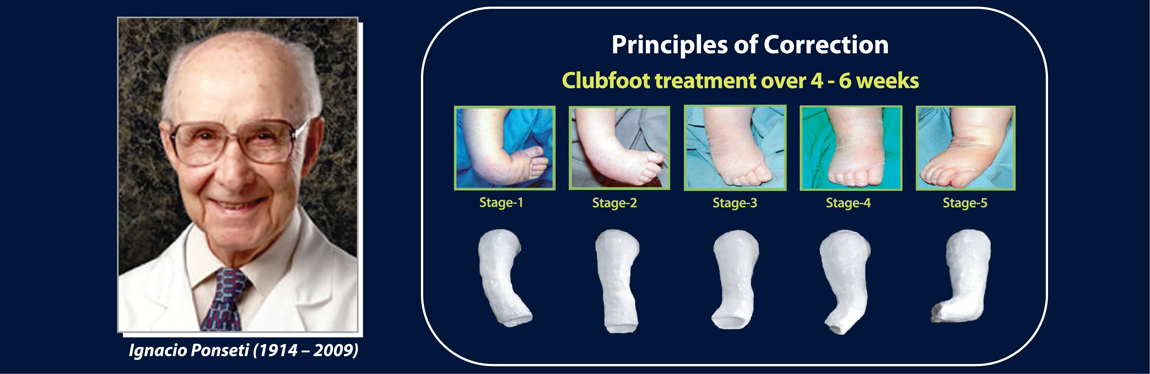 Ponseti Solution - Walk For Life