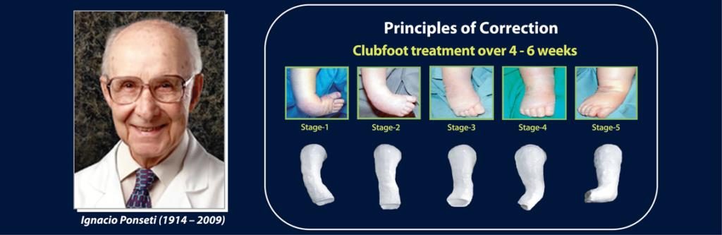 Dr. Ignacio Ponseti and Principles of Correction diagram showing 5 stages of clubfoot treatment